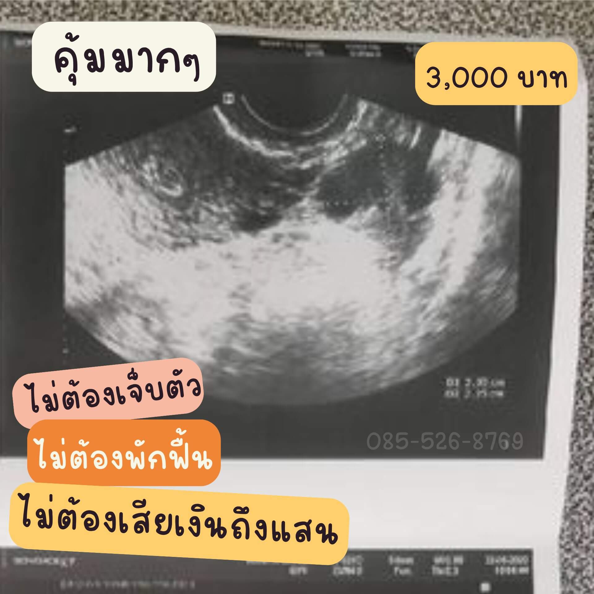 รักษา เนื้องอก ซีสต์ มดลูก รังไข่ เต้านม